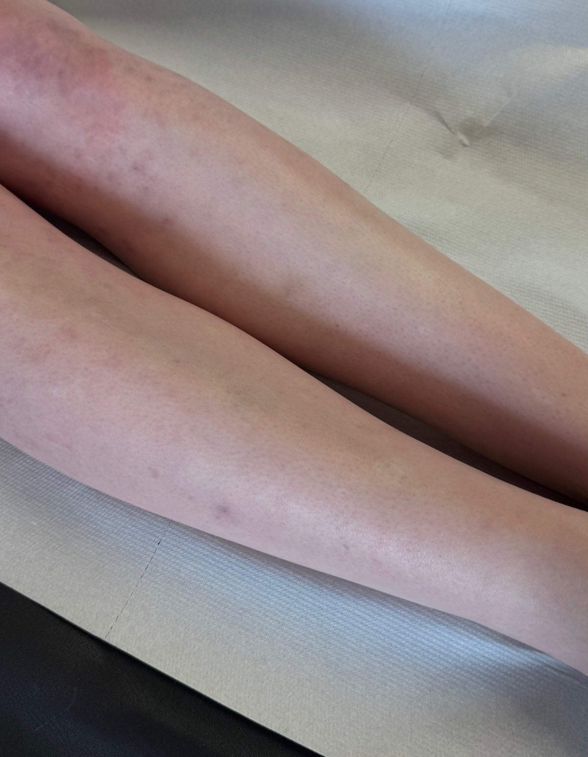 Full Leg Laser Hair Removal