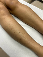 Full Leg Laser Hair Removal