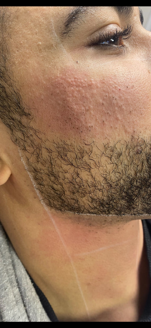 Beard Shaping Laser Hair Removal