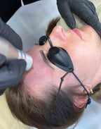 Eyebrow Tattoo Laser Removal