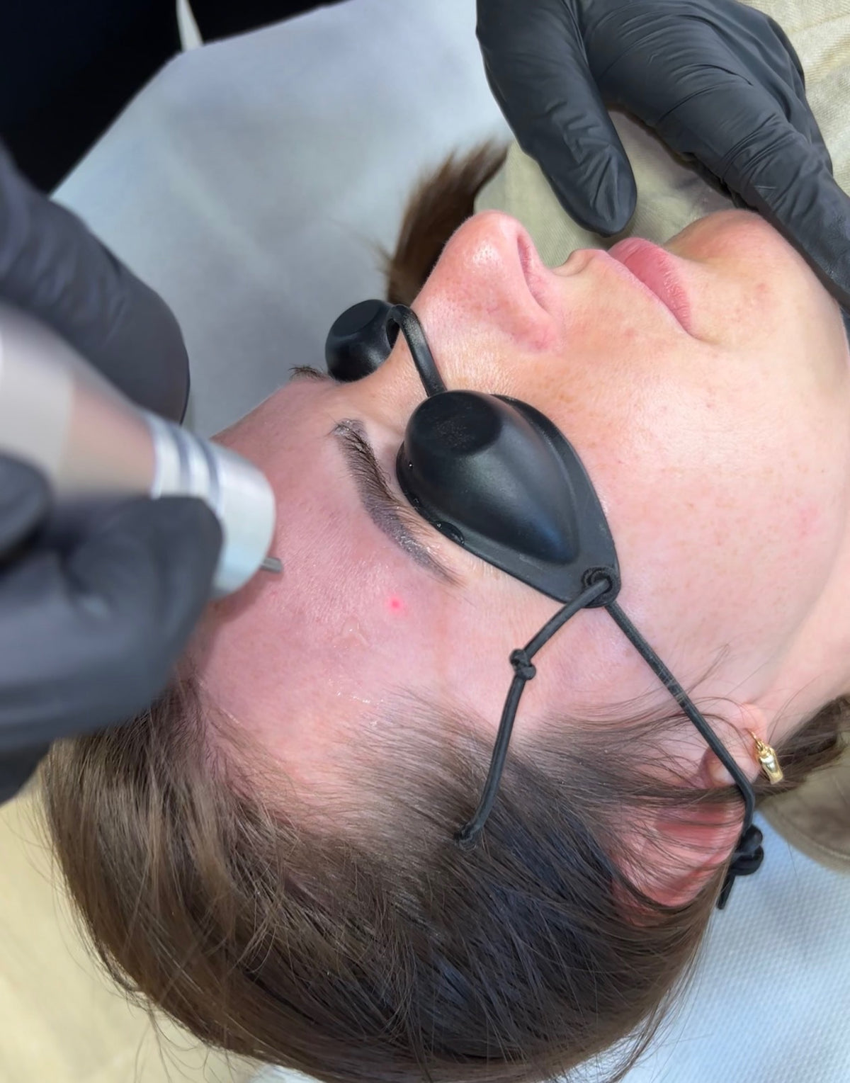 Eyebrow Tattoo Laser Removal
