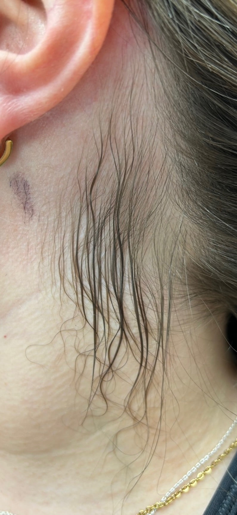 Neck Shaping Laser Hair Removal