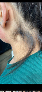 Neck Shaping Laser Hair Removal