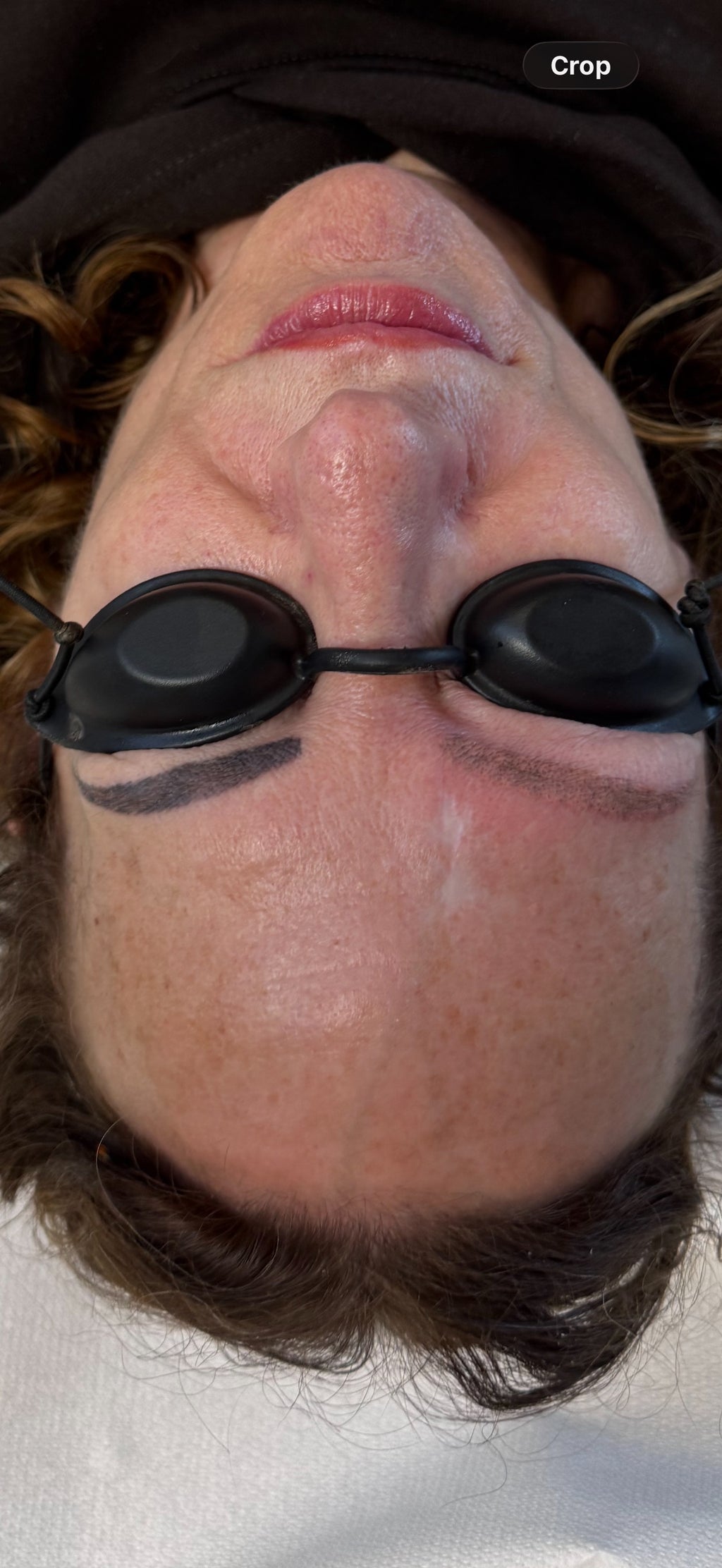 Eyebrow Tattoo Laser Removal