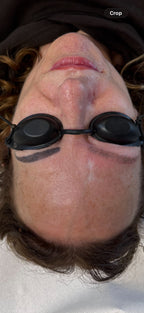 Eyebrow Tattoo Laser Removal