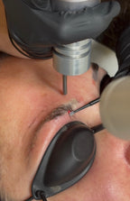 Eyebrow Tattoo Laser Removal