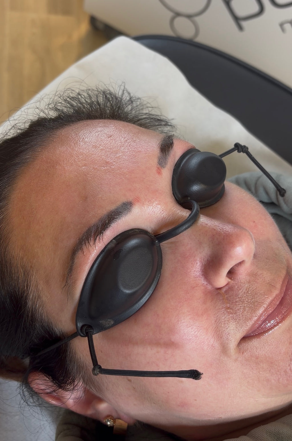 Eyebrow Tattoo Laser Removal
