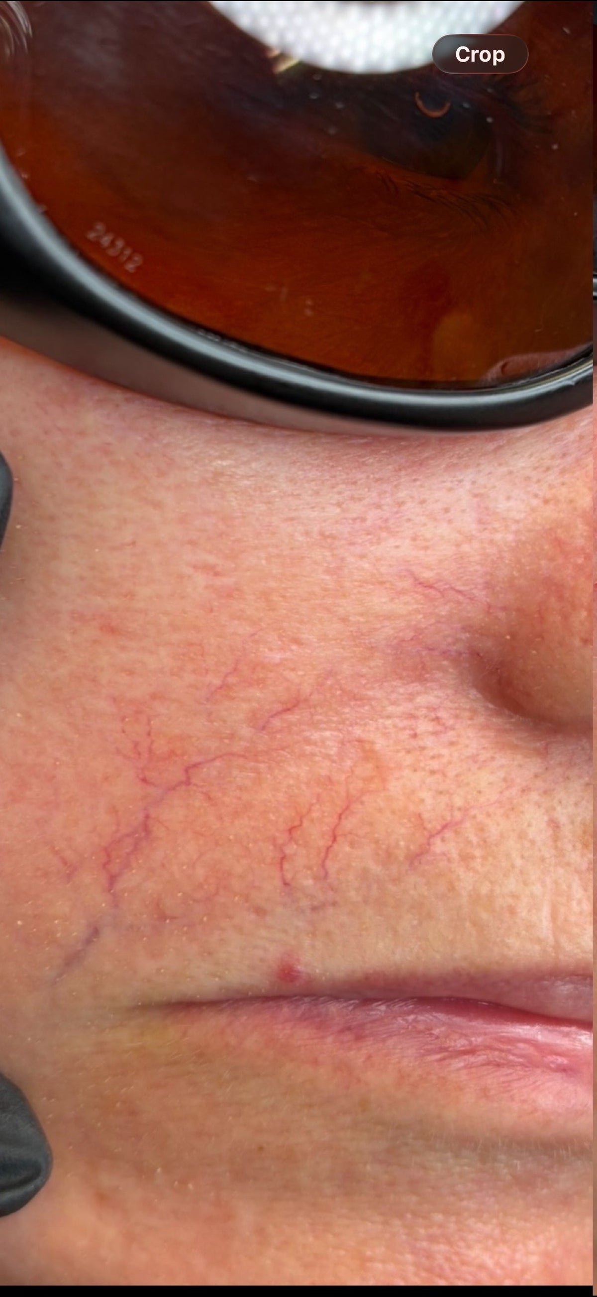 Thread & Spider Vein Laser Removal