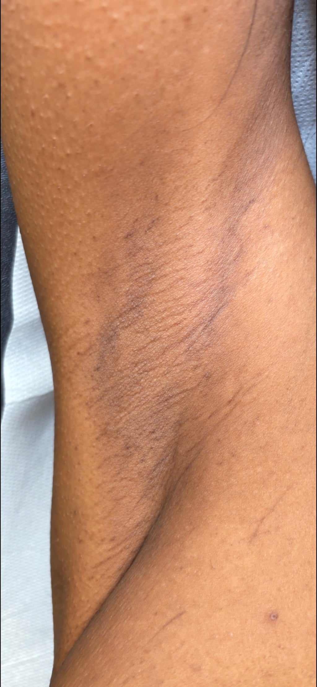 Underarm Laser Hair Removal