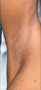 Underarm Laser Hair Removal