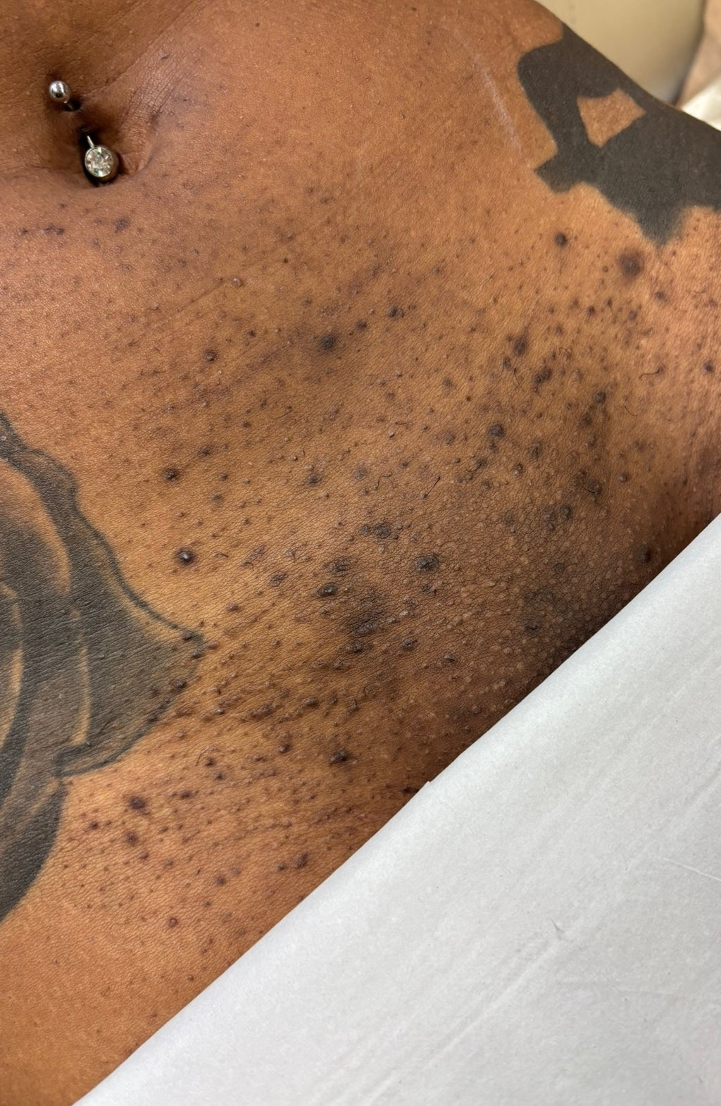 Hollywood Including Perianal Laser Removal
