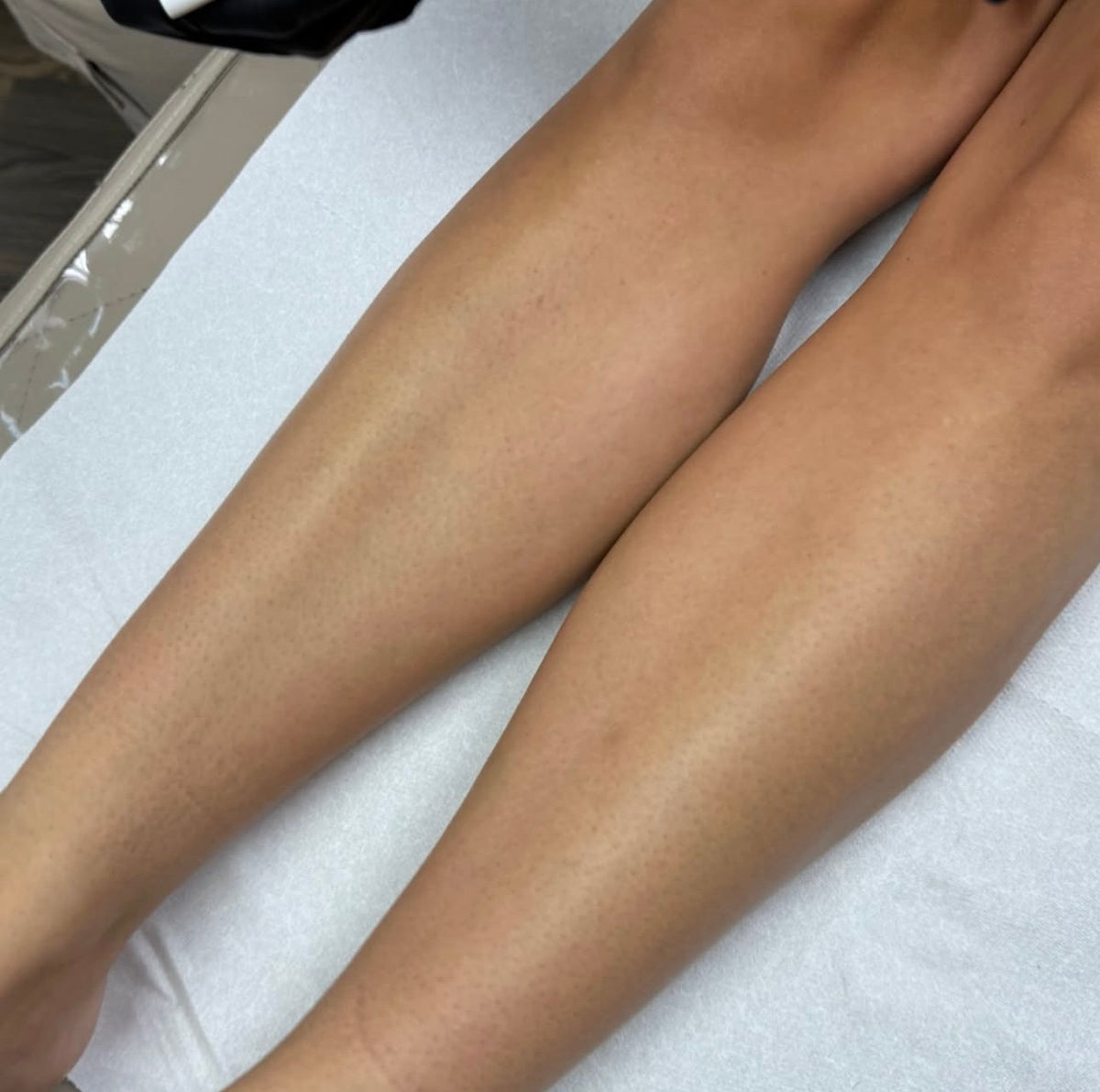¾ Leg Laser Hair Removal