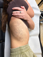 Body Laser Tattoo Removal