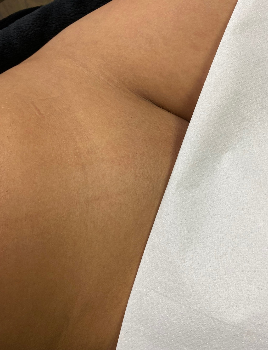 Hollywood Including Perianal Laser Removal