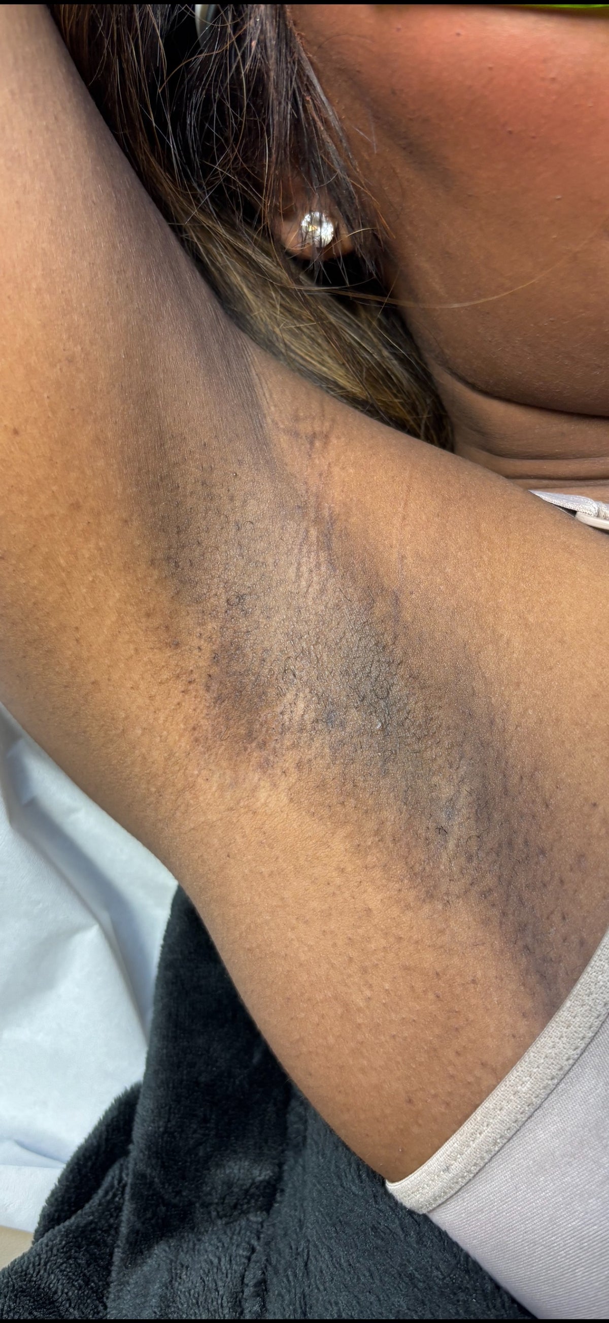 Underarm Laser Hair Removal