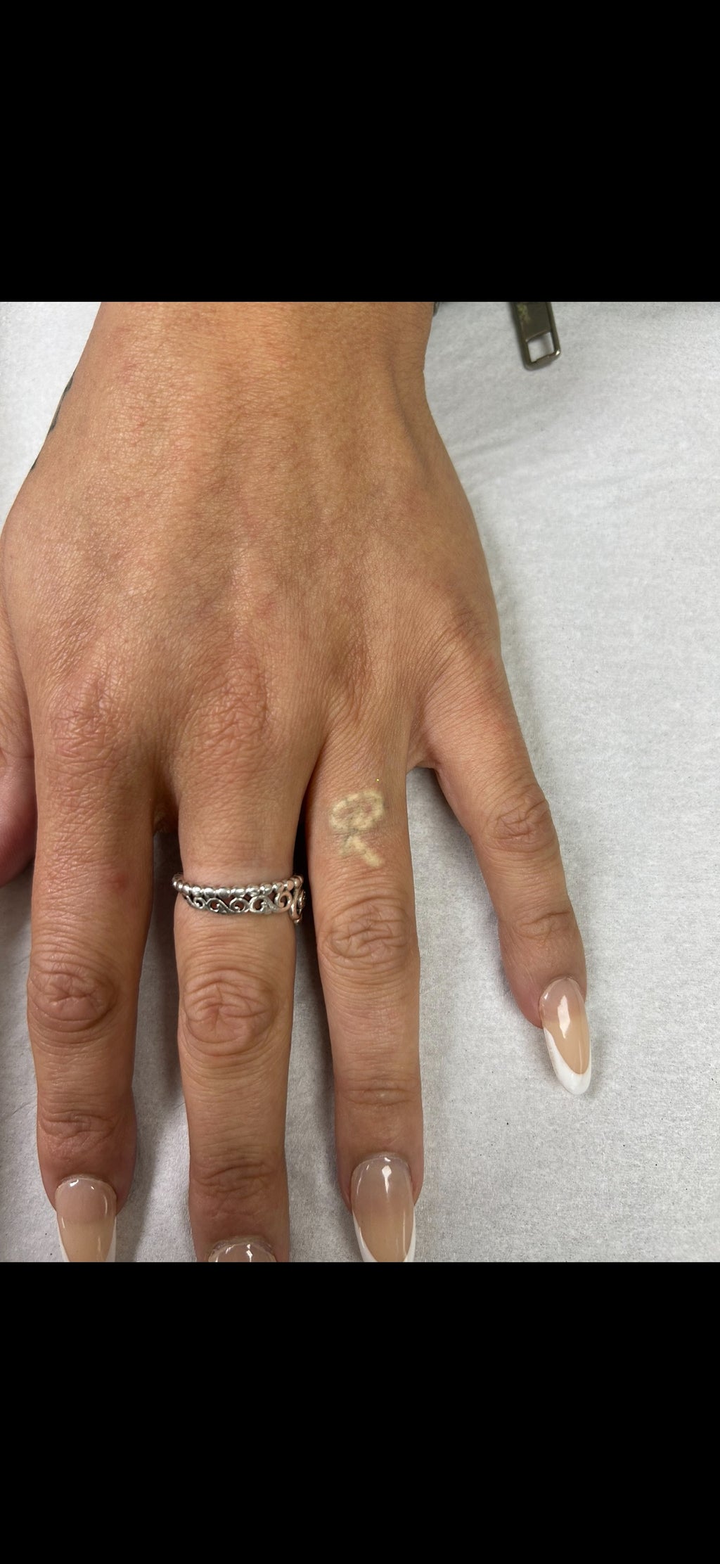 Hand, Neck & Face Laser Tattoo Removal