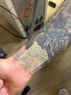 Body Laser Tattoo Removal
