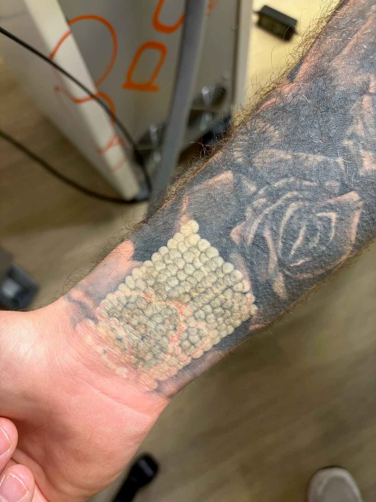 Body Laser Tattoo Removal