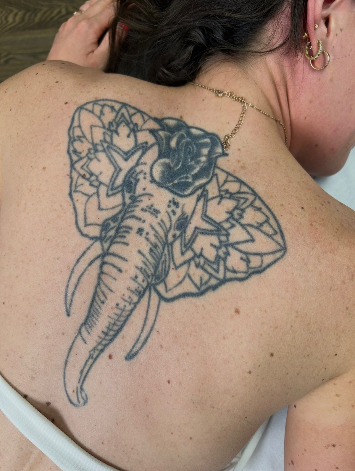 Body Laser Tattoo Removal