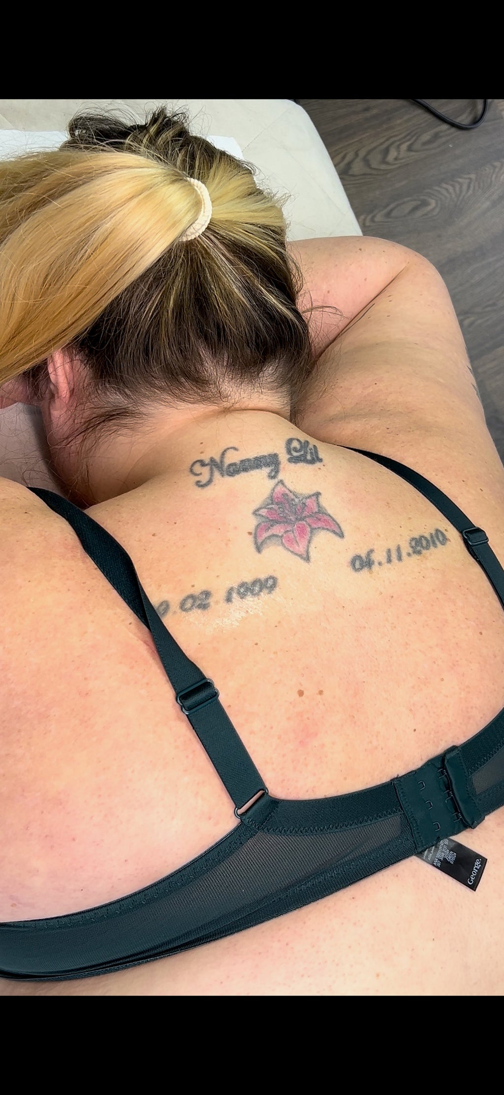 Body Laser Tattoo Removal