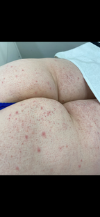 Bum Laser Hair Removal