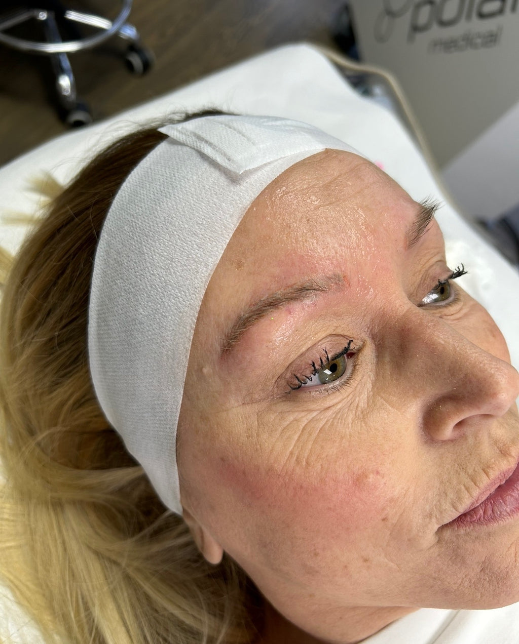 Eyebrow Tattoo Laser Removal