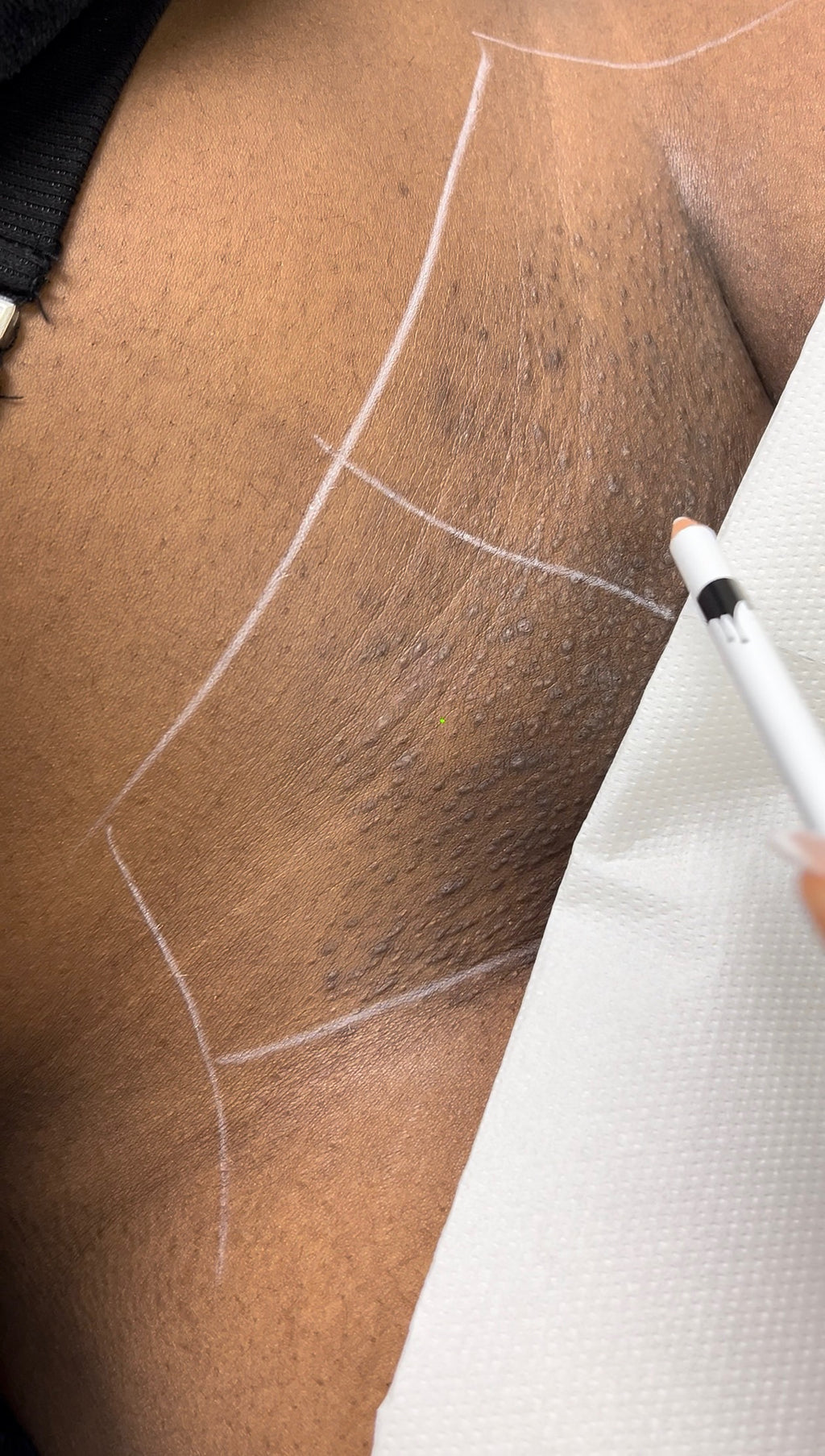 Hollywood Including Perianal Laser Removal
