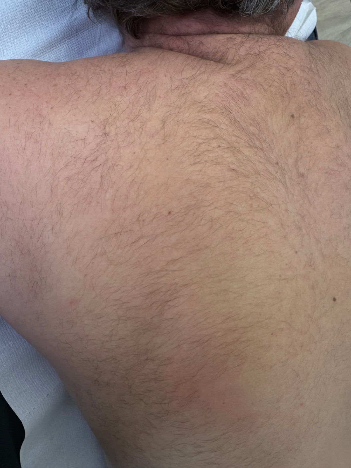 Full Back Laser Hair Removal