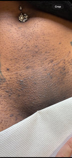 Hollywood Including Perianal Laser Removal