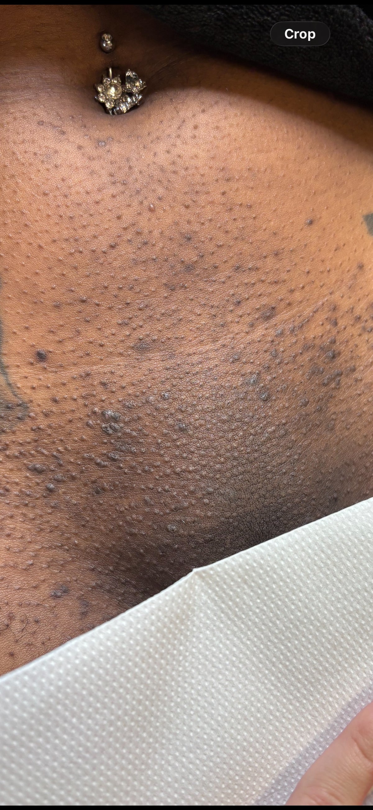 Hollywood Including Perianal Laser Removal