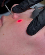 Thread & Spider Vein Laser Removal