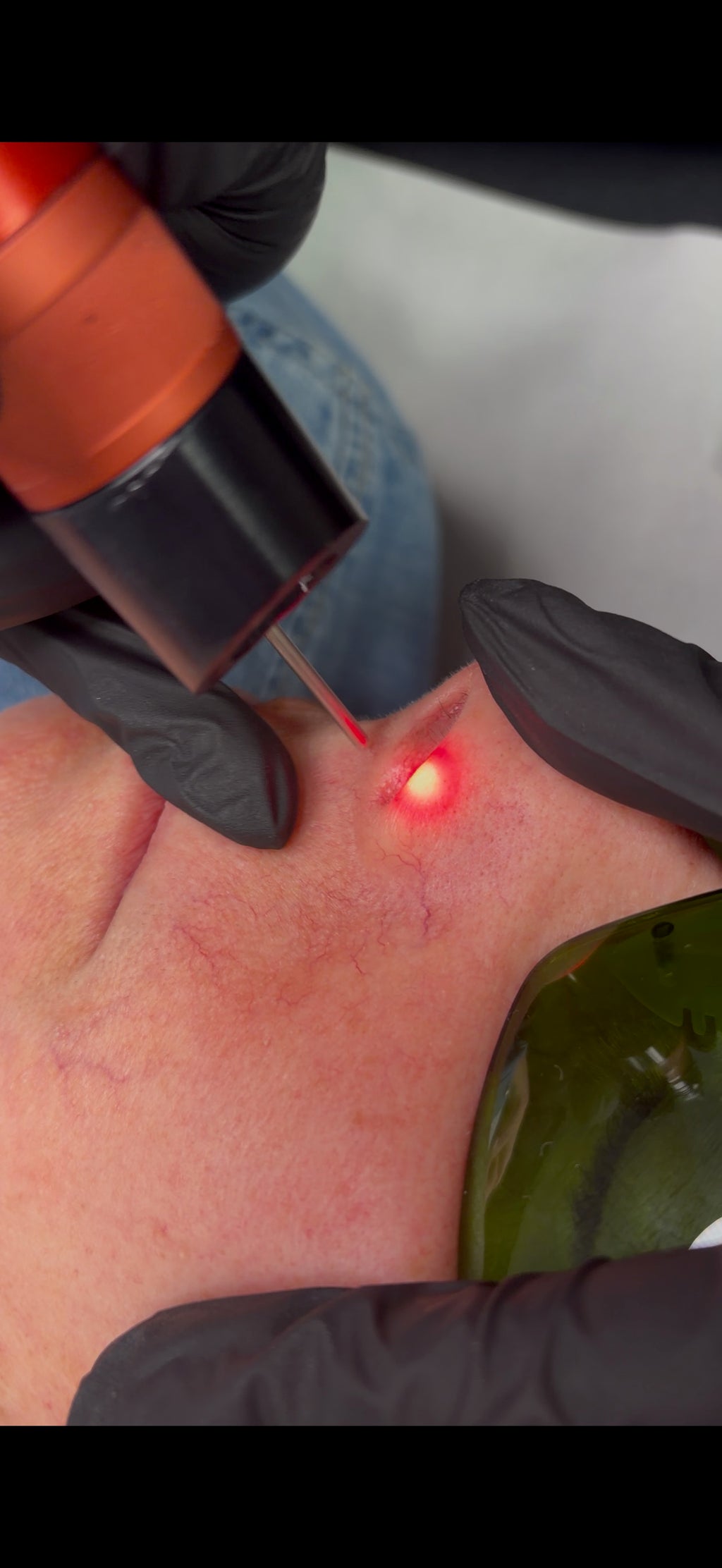 Thread & Spider Vein Laser Removal