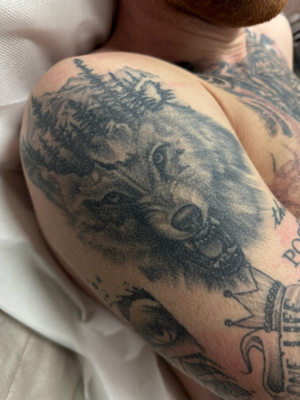 Body Laser Tattoo Removal