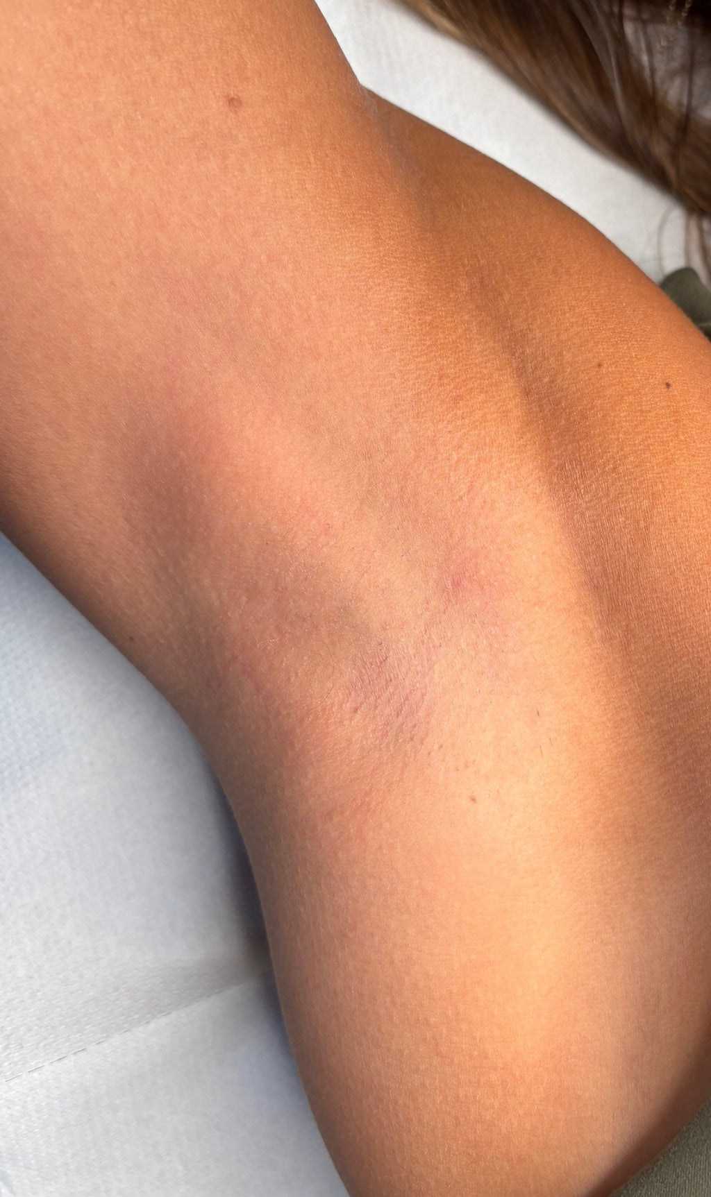 Underarm Laser Hair Removal
