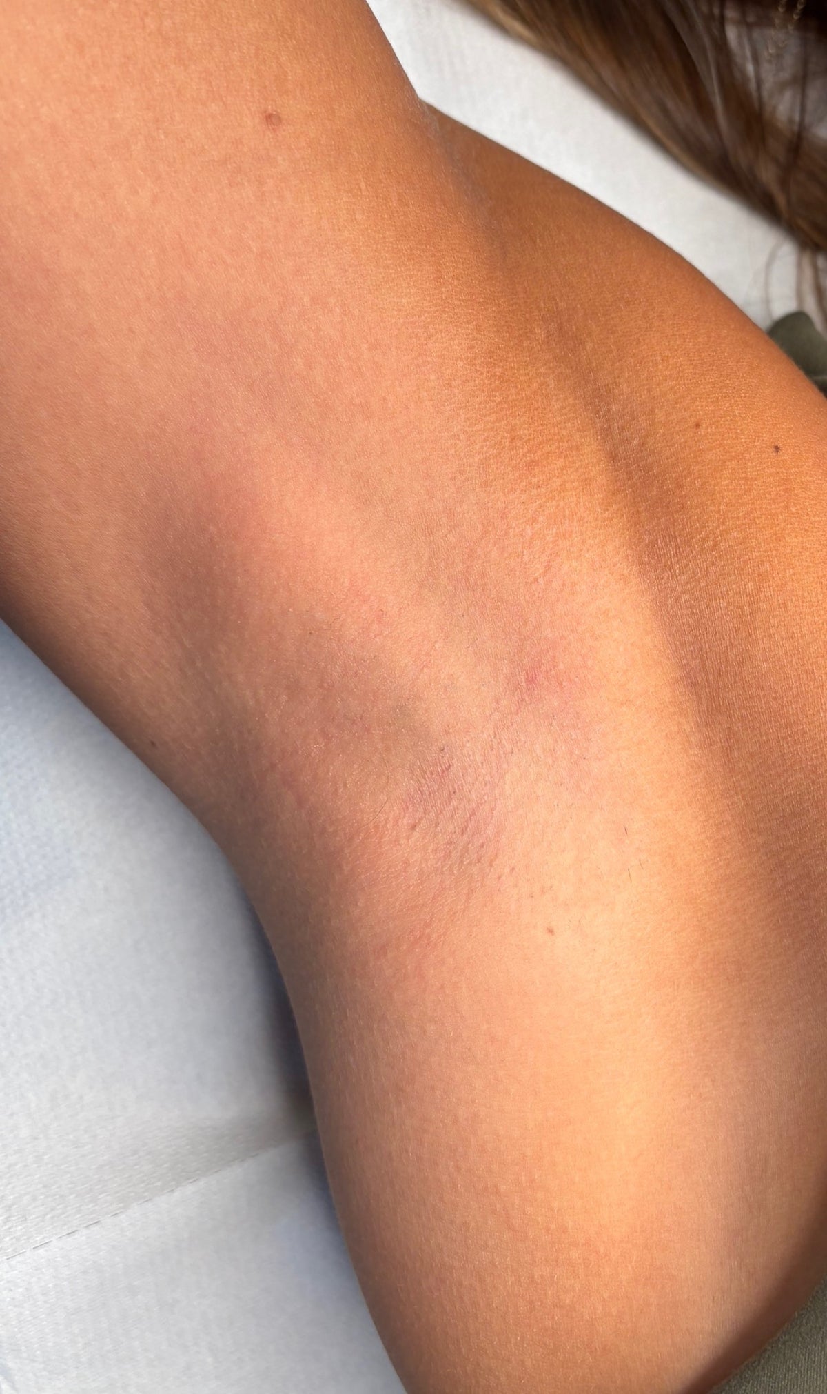 Underarm Laser Hair Removal