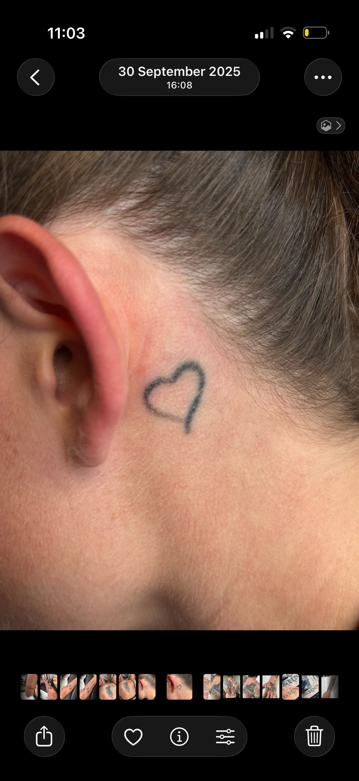 Hand, Neck & Face Laser Tattoo Removal