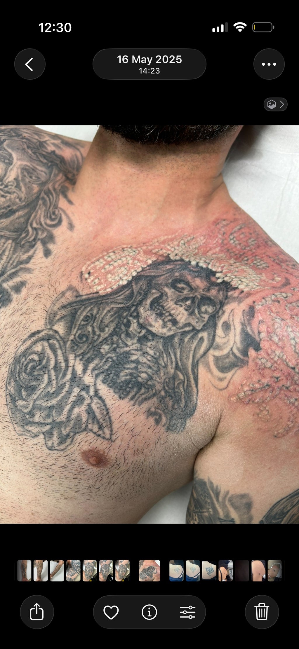 Body Laser Tattoo Removal