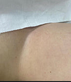 Inner Thigh Laser Hair Removal