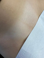 Hollywood Including Perianal Laser Removal