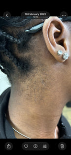 Neck Shaping Laser Hair Removal