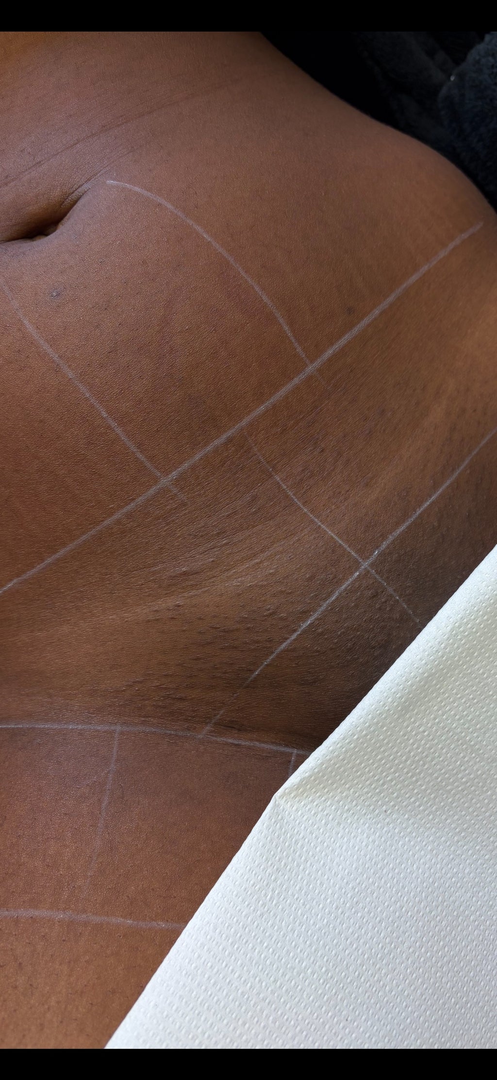 Hollywood Including Perianal Laser Removal