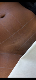 Hollywood Including Perianal Laser Removal
