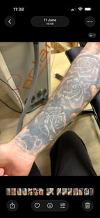 Body Laser Tattoo Removal