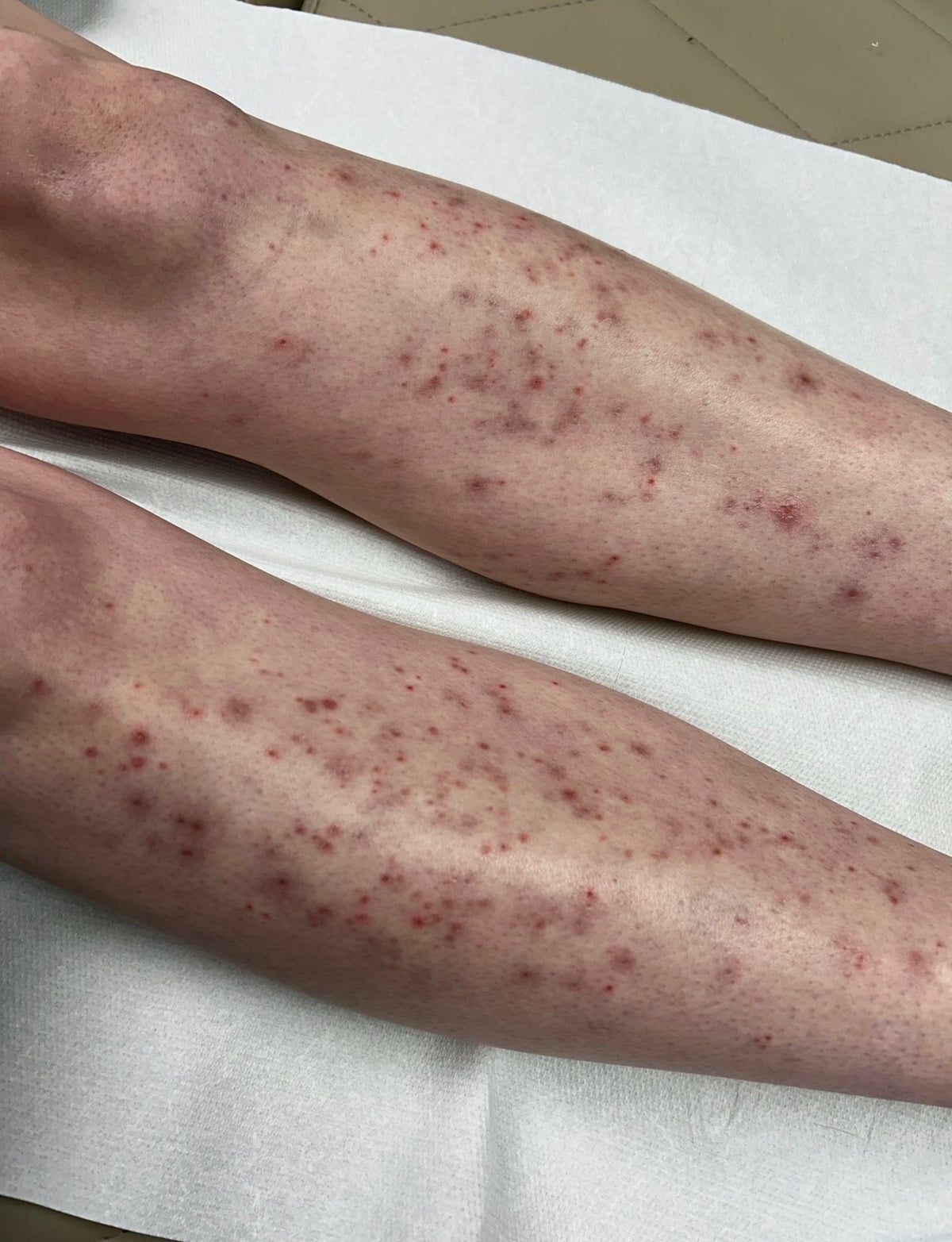 Full Leg Laser Hair Removal