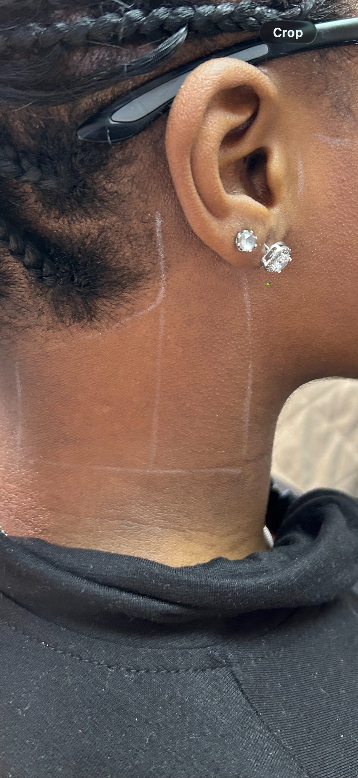 Neck Shaping Laser Hair Removal