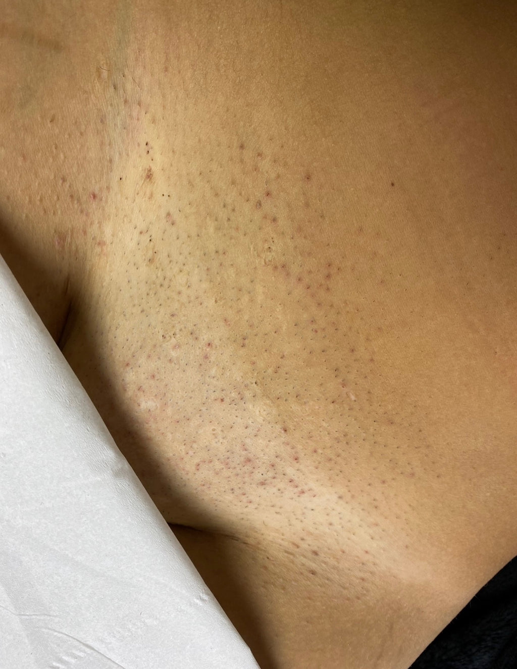 Hollywood Including Perianal Laser Removal