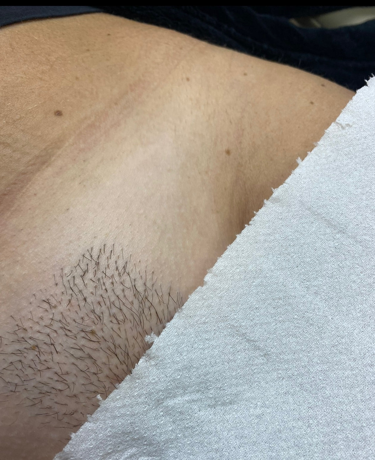 Brazilian Laser Hair Removal