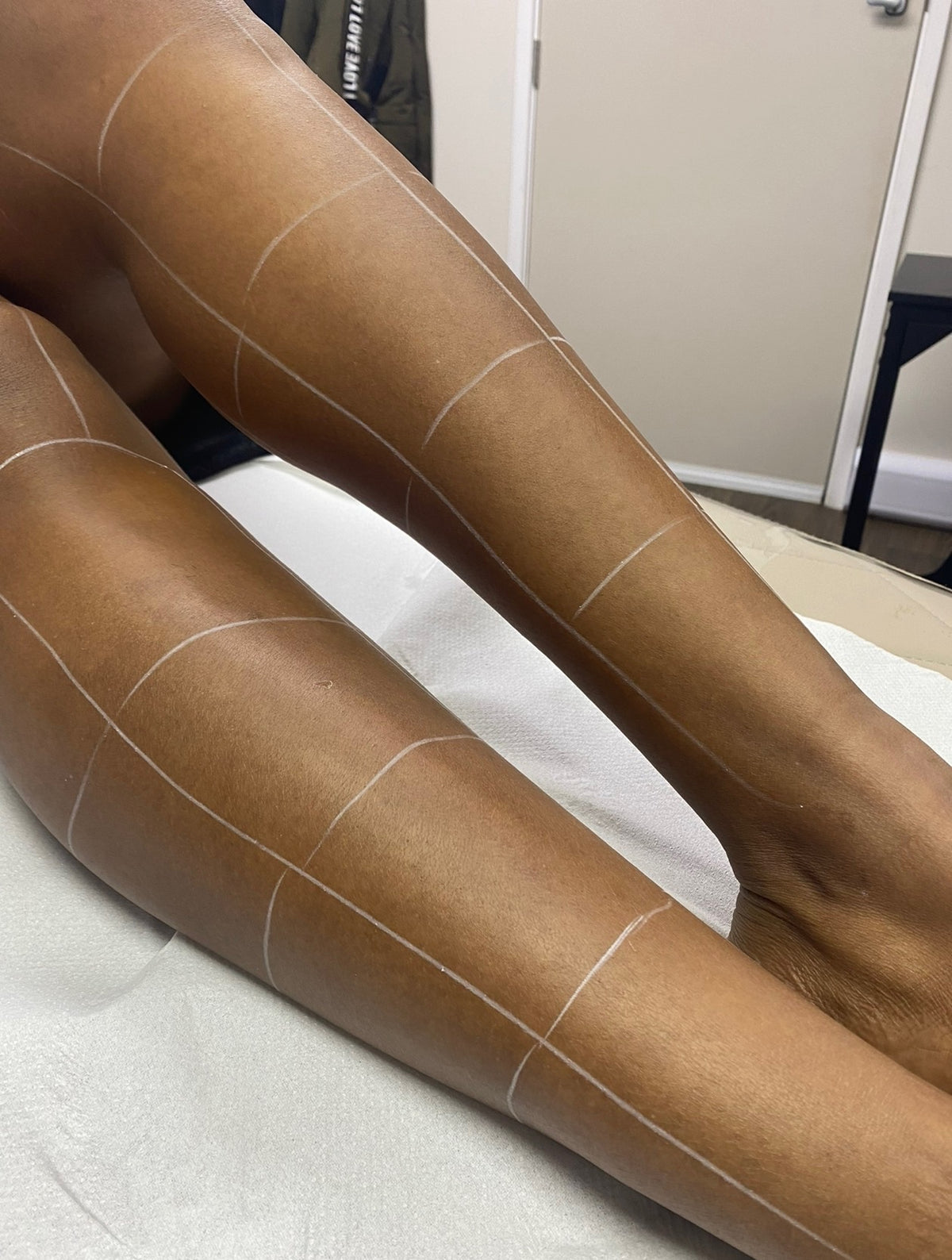 Full Leg Laser Hair Removal