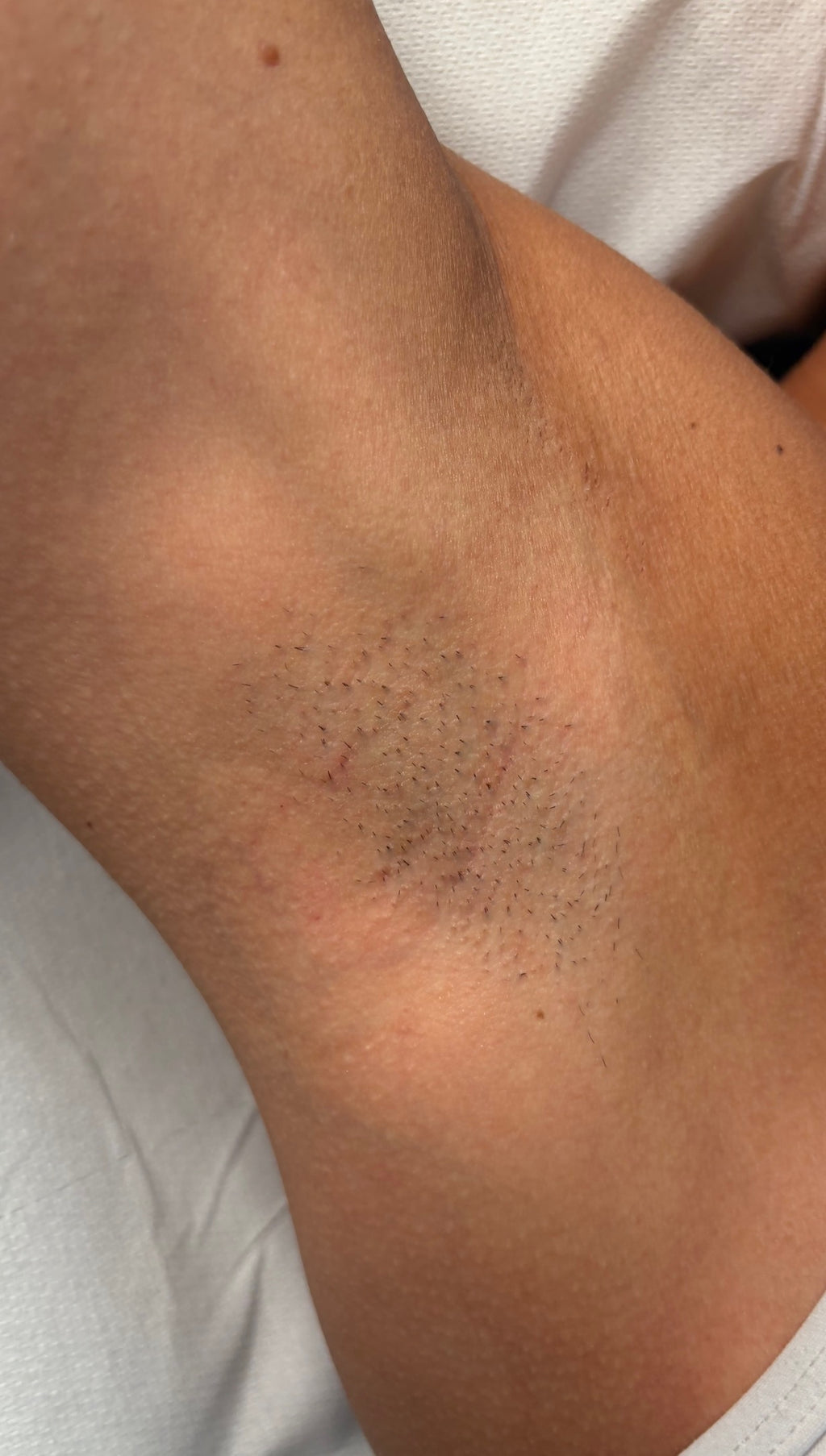 Underarm Laser Hair Removal
