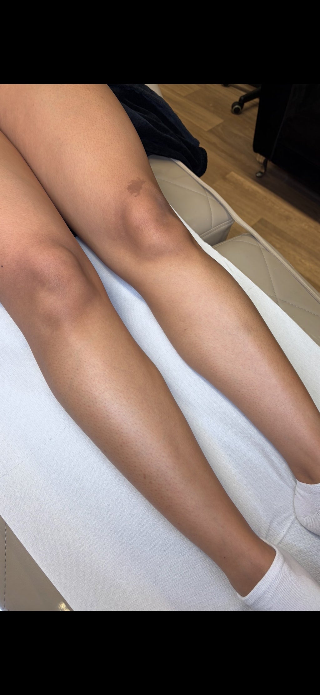 Full Leg Laser Hair Removal